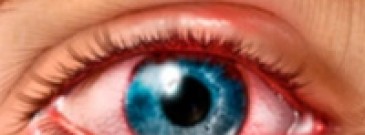 Воспалительные заболевания глаз