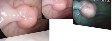 Виртуальная хромоэндоскопия i-Scan 