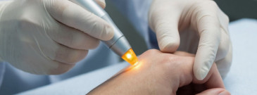 Удаление бородавок