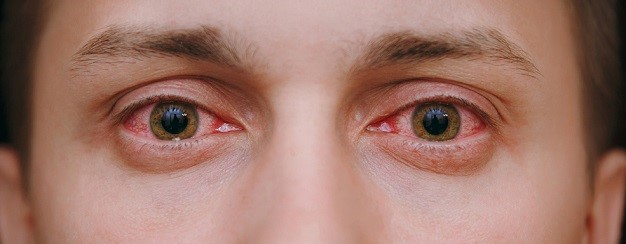 Что может быть причиной сильного зуда глаз и как с ним бороться