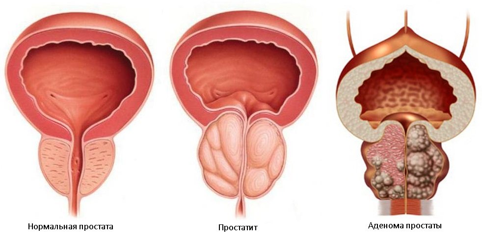 Biopsie de prostata sau un simplu test de urina?